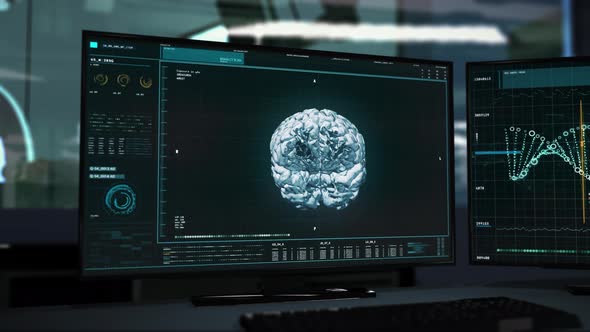 Radiologistic research process concludes with the finding of Brain Tumor inside alt