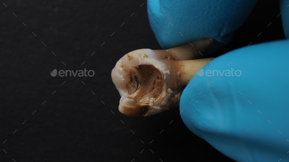Tooth decay and dentist hand with glove and black background. Stock ...