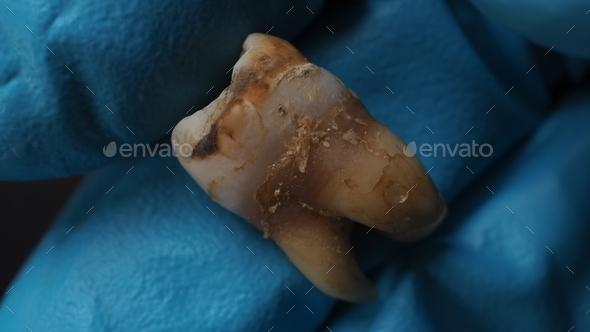 Tooth decay and dentist hand with glove and black background. Stock ...