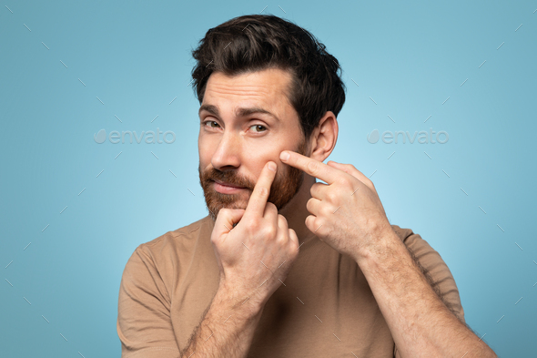 Portrait of bearded man touching his face, pressing pimple on face with fingers, looking at camera