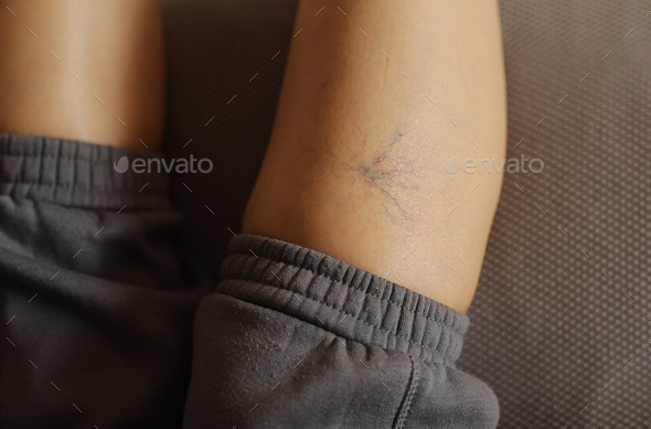 Painful varicose and spider veins on womans legs, who is active at home. Two active seniors