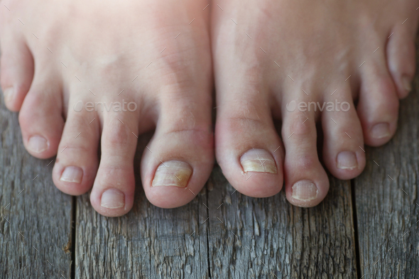 Onycholysis: exfoliation of the nail from the nail bed. - Stock Photo - Images