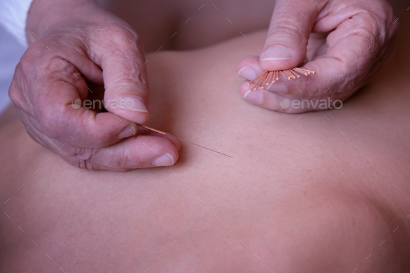 Back acupuncture of a woman - Stock Photo - Images
