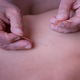 Back acupuncture of a woman - PhotoDune Item for Sale