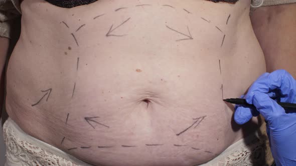 The Surgeon Marks the Abdomen for Liposuction alt