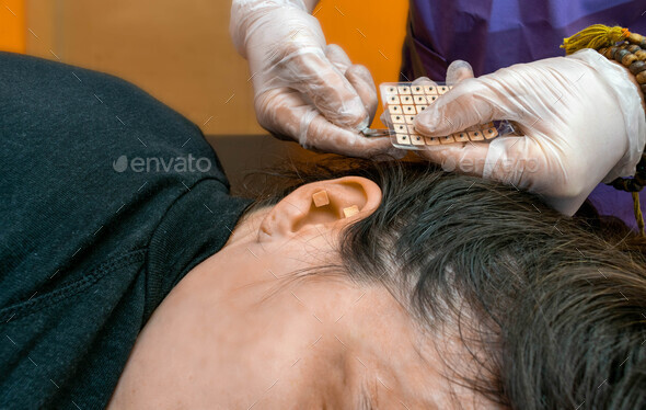 Auriculotherapy by using needles and pressure points