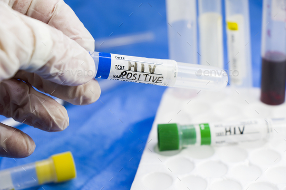 Closeup of a doctor with a latex glove holding an HIV positive test tube in the laboratory