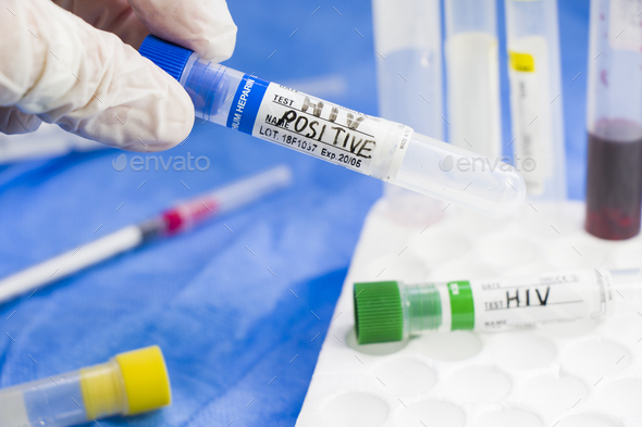 Closeup of a doctor in latex gloves holding an HIV POSITIVE test tube in the laboratory