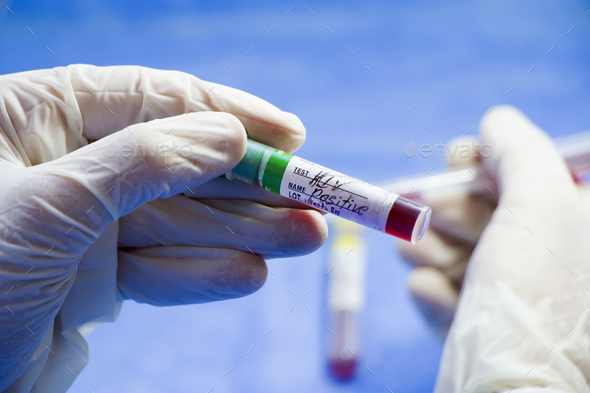 Doctor with a latex glove holding an HIV positive test tube in the laboratory