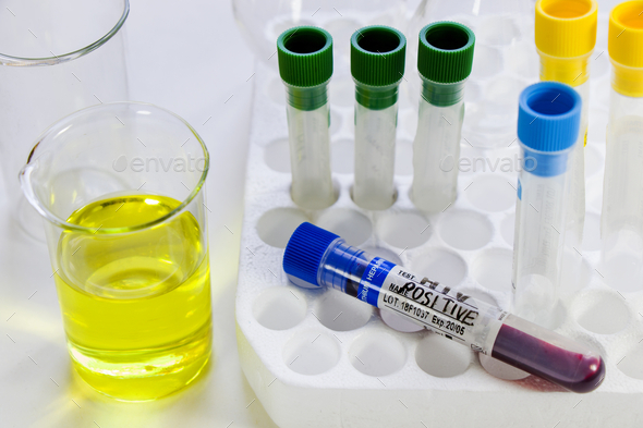 Closeup of an HIV POSITIVE test tube with beakers on the table in a laboratory