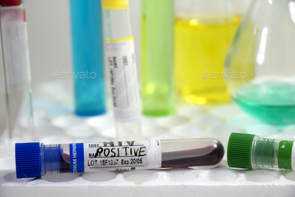 Closeup shot of HIV positive blood specimen on a test tube in the laboratory