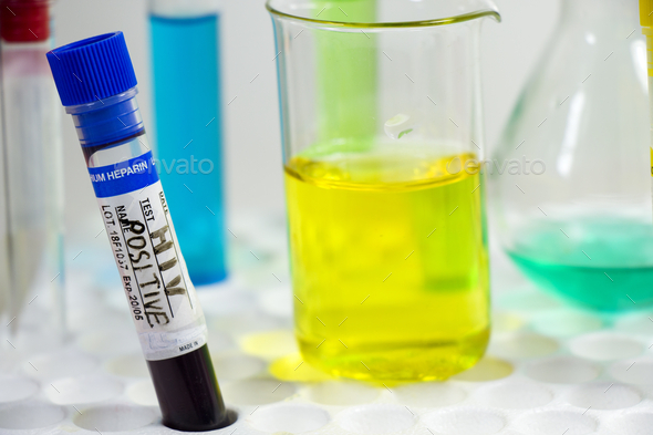 Closeup of an HIV positive blood test tube and chemical beakers on the table in the laboratory