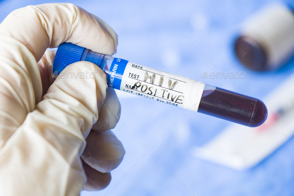Closeup of a doctor in latex gloves holding an HIV POSITIVE test tube in the laboratory