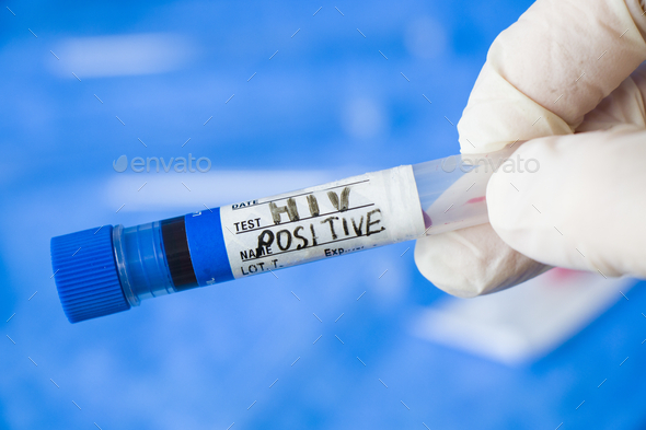 Closeup of a doctor with a latex glove holding an HIV POSITIVE test tube in the laboratory