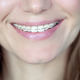 Adult woman with a braces - PhotoDune Item for Sale