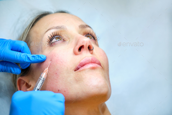 woman over 40 years old undergoing anti-wrinkle aesthetic treatment with hyaluronic acid injection