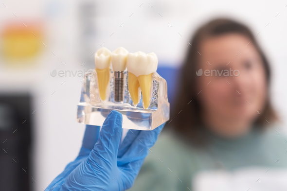 close-up patient dental implant treatment plan. The focus is teeth implant model in dentists hand