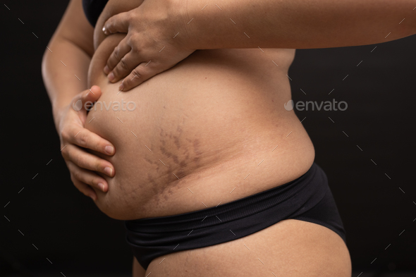 Female hanging belly with stretch marks on skin closeup. Overweight woman  flaunt figure Stock Photo by burmistrovaiuliia