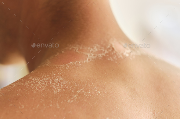 unrecognizable guy got sunburn and got tan lines on his back.