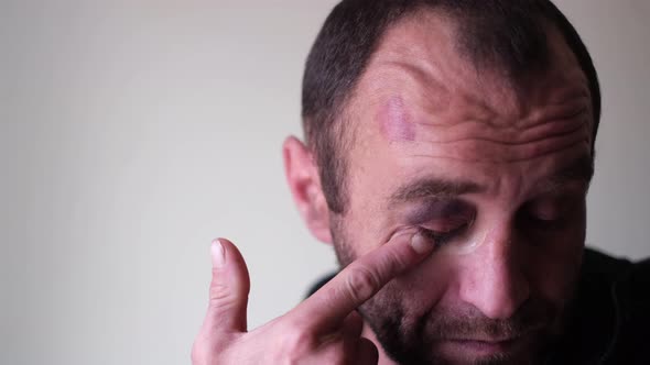 An Alcoholic Man Lubricates the Hematoma Cream Under the Eye alt