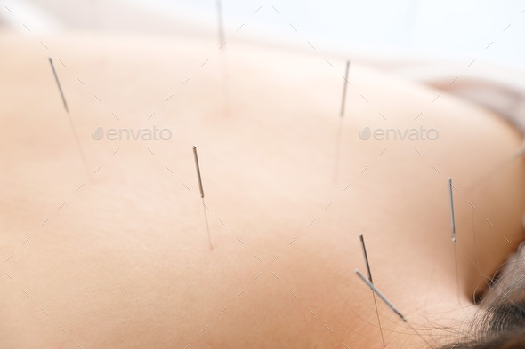 A woman with a needle stuck to her back at a bright acupuncture clinic