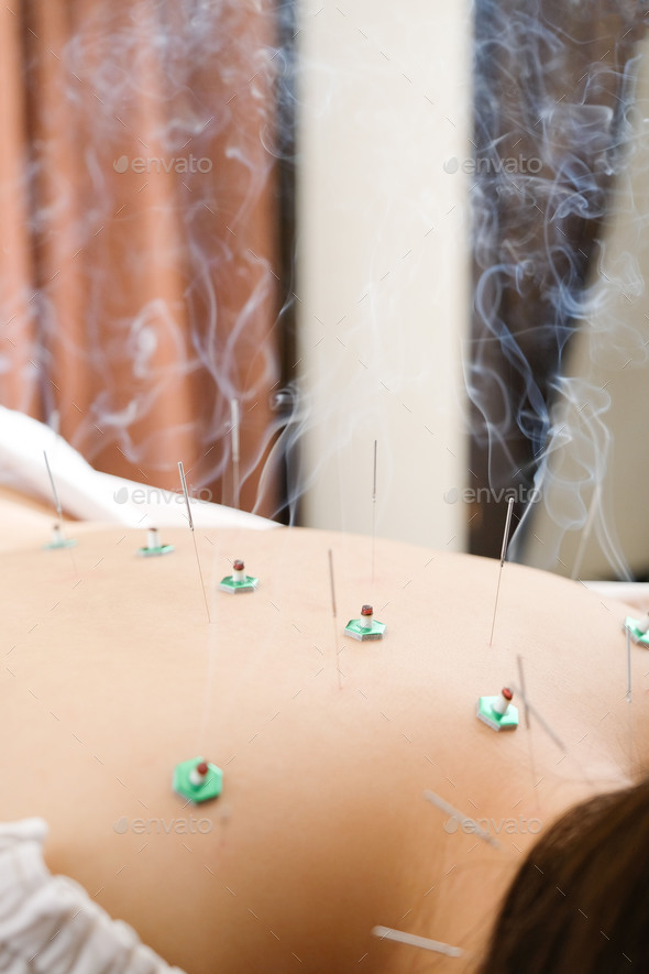 A woman with a needle stuck to her back at a bright acupuncture clinic