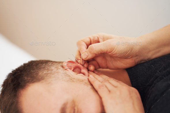 A picture of a man having acupuncture on ear - Stock Photo - Images