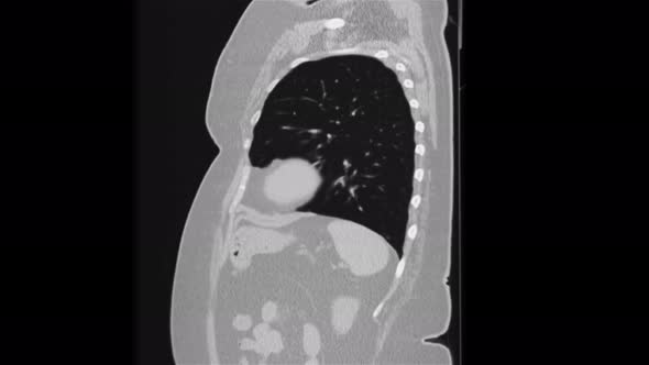 Purified MRI of the Lungs and Bronchi, Diagnosis of Viral Respiratory Disease alt