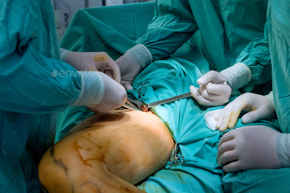 To access remove these veins surgeon makes small incision near affected vein - Stock Photo - Images