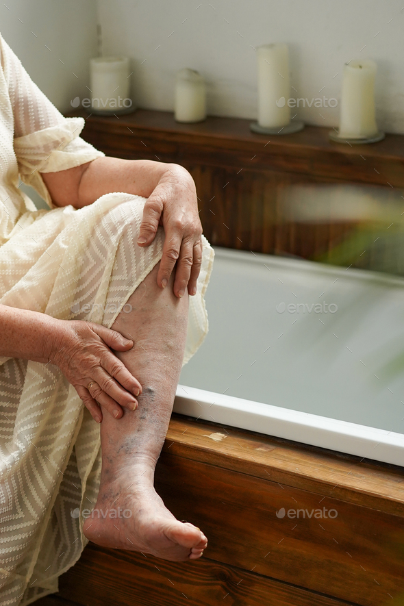 Legs of old woman with varicose veins. Stock Photo