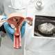 Uterus and ovary, doctor holding anatomy model and ultrasound picture for study diagnosis. - PhotoDune Item for Sale