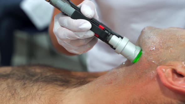 Close up man face depilation laser hair removal procedure treatment alt