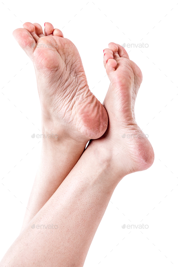 Dry skin fashion calluses feet