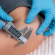 Dermatologist Measures Mole Safeguarding Skin Health - PhotoDune Item for Sale