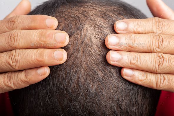 male pattern baldness hair loss or visible scalp
