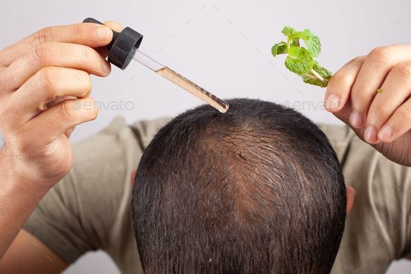 male pattern baldness treatment using Peppermint essential hair oil