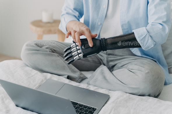 Handicapped woman with artificial arm working on laptop at home. Setting up bionic prosthesis.