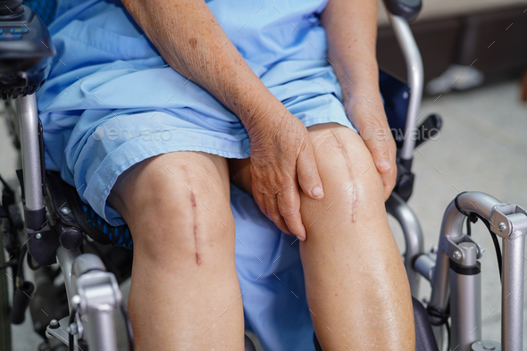 Asian senior woman patient show her scars surgical total knee joint replacement - Stock Photo - Images