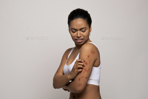 Stressed black woman scratching red spots on her skin - Stock Photo - Images
