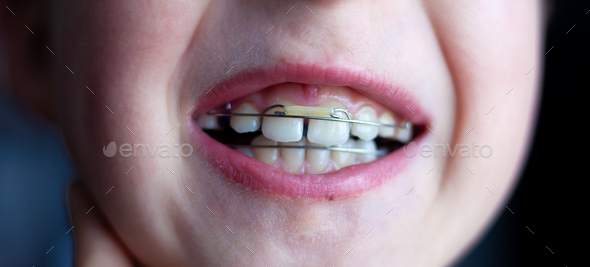 Orthodontist plates on children's teeth. Bite alignment. Orthodontic ...