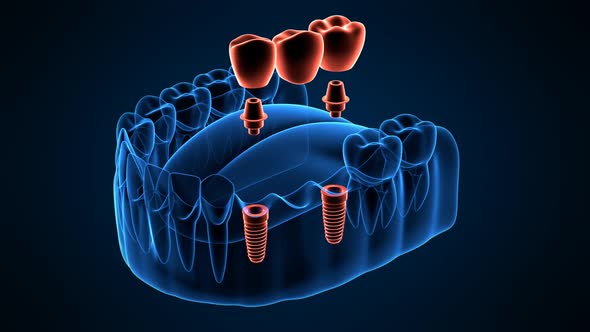 Jaw with implants supporting dental bridge with x-ray effect over dark blue background