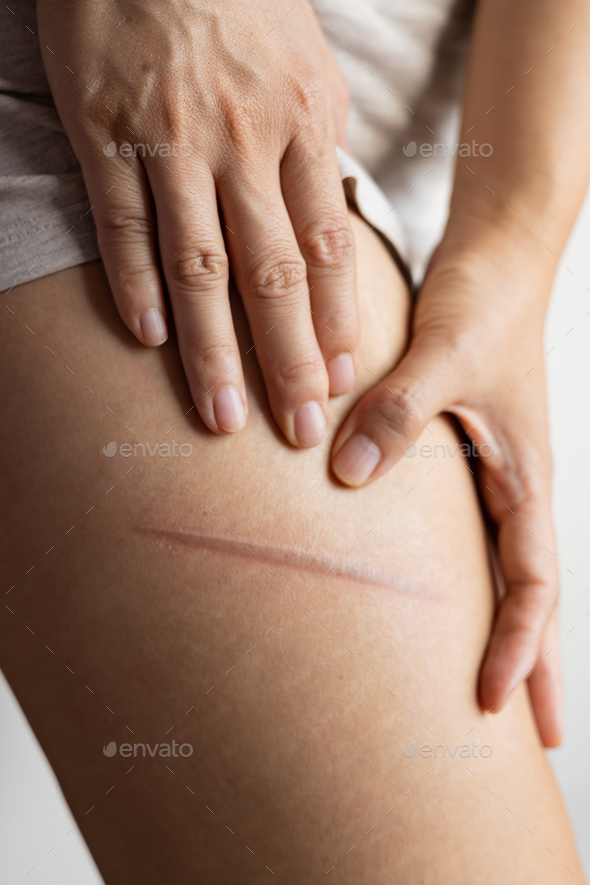 Female leg with thermal burn of the skin. Domestic injury during ironing or cooking. Scars on the le