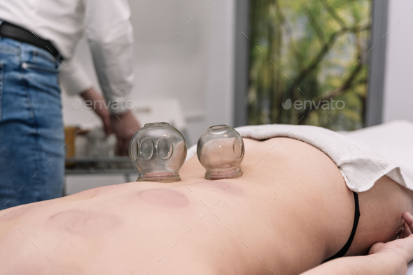 Doctor removes vacuum cupping therapy treatment.Chinese cupping therapy