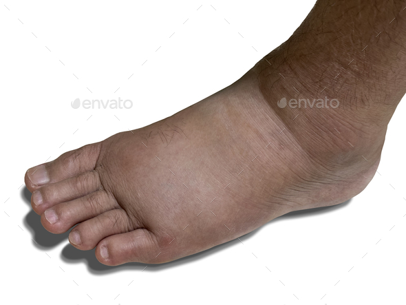 Close-up Swollen Left Foot as a Result of Ankle Pain Isolated on White