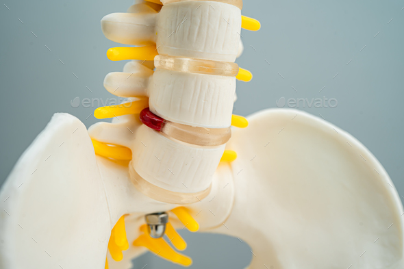 Lumbar spine displaced herniated disc fragment, spinal nerve and bone. Model for treatment medical.