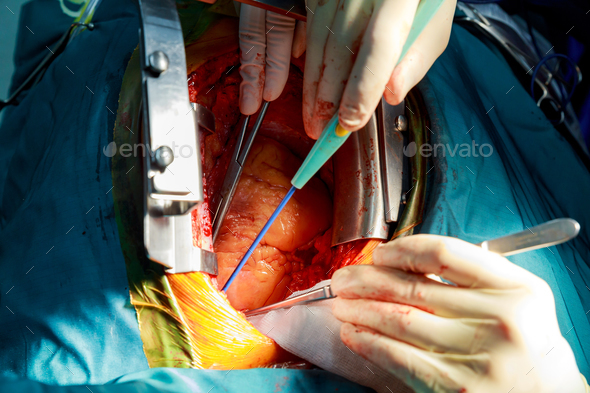Disposable electrosurgical pencil. Incision on the chest. Cutting the chest during an operation on