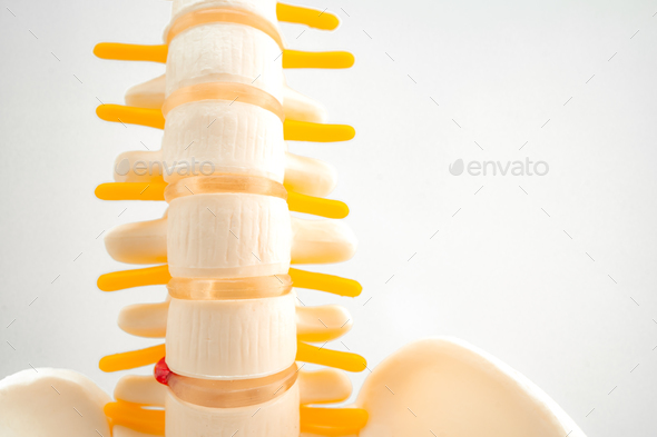 Lumbar spine displaced herniated disc fragment, spinal nerve and bone. Model for treatment medical i