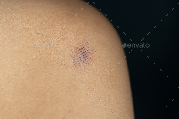 Marks after laser hair or scar removal from the skin. CO2 technique.