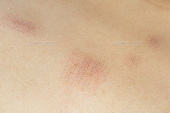 Marks after laser hair or scar removal from the skin. CO2 technique.