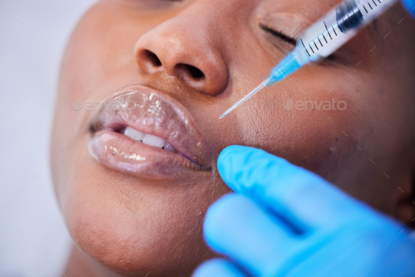 Plastic surgery, needle and black woman with lip filler closeup on a hospital bed with dermatology.